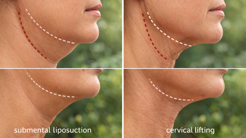 Haeckel Cabral Moraes ressalta que identificar a causa do volume no pescoço é essencial para escolher a técnica correta.